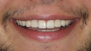 Aparelho Fixo Autoligável Bimaxilar e Facetas em Compósito