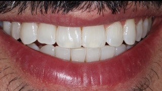 Branqueamento Dentário