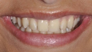 Reabilitação Fixa sobre Implantes Dentários