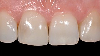 Correção de Manchas