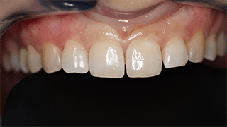 Restauração estética com colocação de resina composta direta