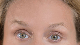 Aplicação de Botox®️