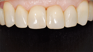 Restauração Direta em Compósito