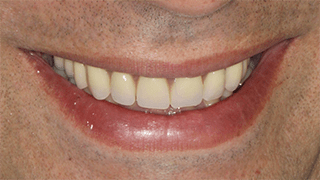 Implantes Dentários e Prótese Fixa em Cerâmica