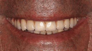 Implantes Dentários e Prótese Fixa em Cerâmica