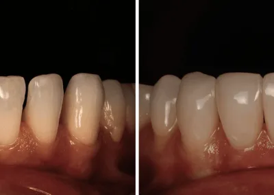 Caso Clínico — Restaurações Diretas