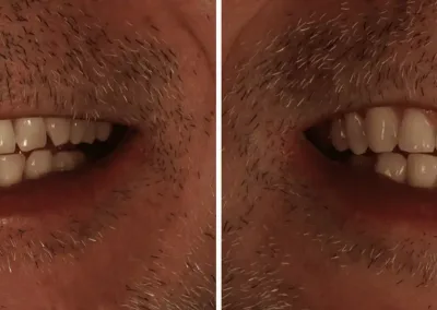 Caso Clínico — 6 restaurações diretas em resina composta