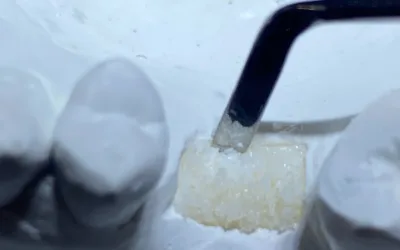 Enxerto ósseo para a colocação de implantes dentários