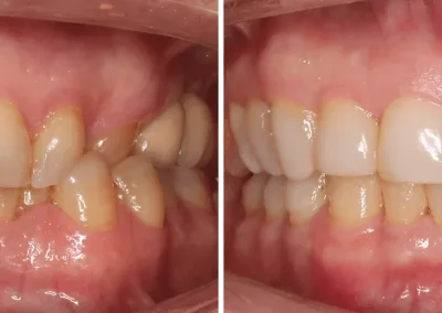 Caso Clínico — Ortodontia, Dentisteria e Implantologia