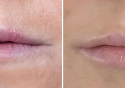 Caso Clínico — Preenchimento com Ácido Hialurónico