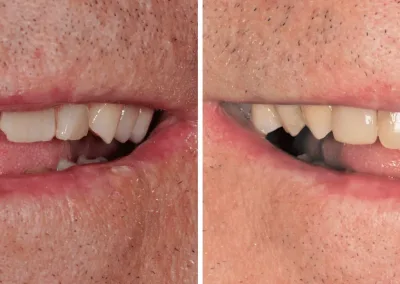 Caso Clínico — Restaurações Diretas