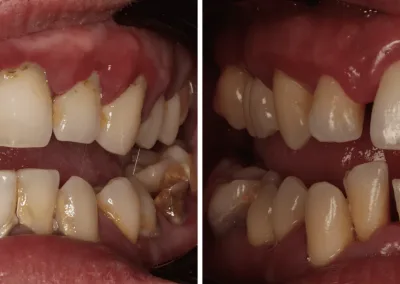 Caso Clínico — Guided Biofilm Therapy (GBT)