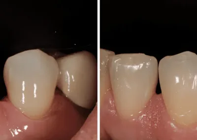 Caso Clínico — Restaurações Diretas