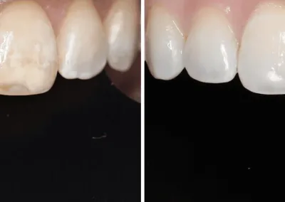 Caso Clínico — Icon DMG® System