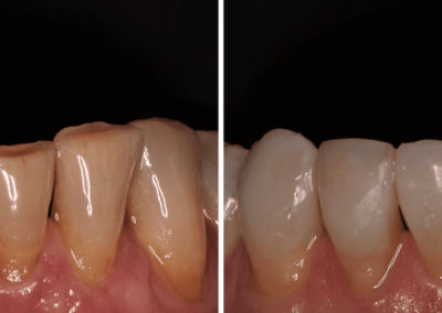 Caso Clínico — Restauração Direta em Resina Composta