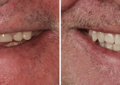 Caso Clínico — Implantes, Facetas e Coroas Dentárias